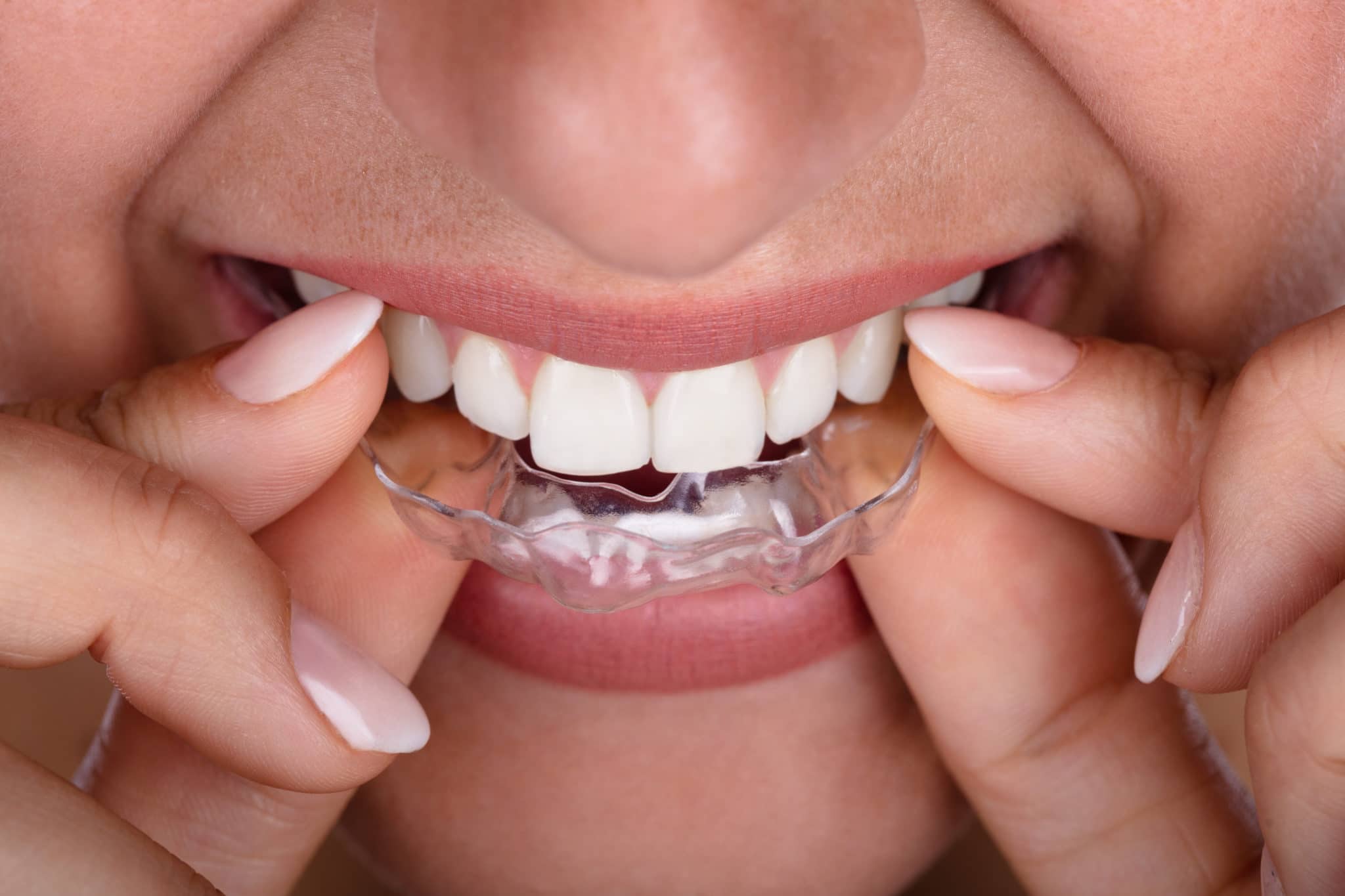 veneers can straighten teeth without braces